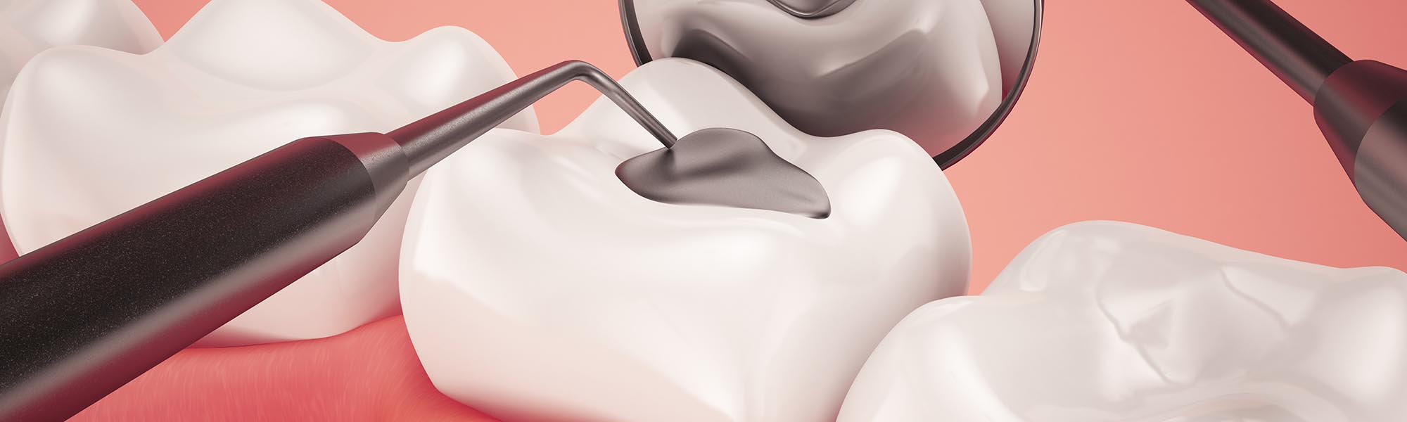 Composite Fillings care in Carson CA