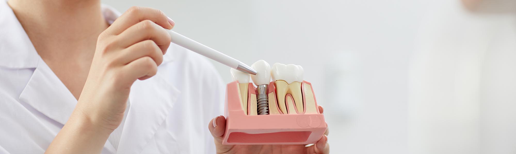 Single Tooth Implants in Carson CA